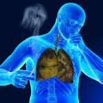 What Is A Smokers Cough And Will It Ever Stop?
